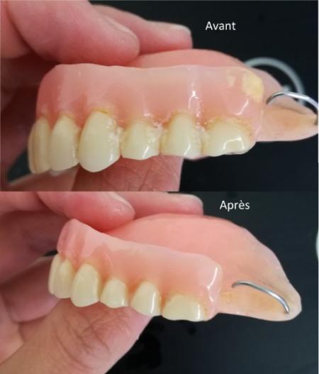 Tartre et coloration de votre dentier : faites un détartrage par votre prothésiste